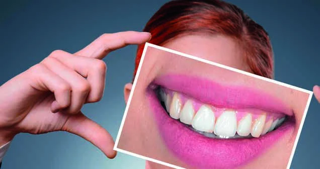 Zahnbleaching